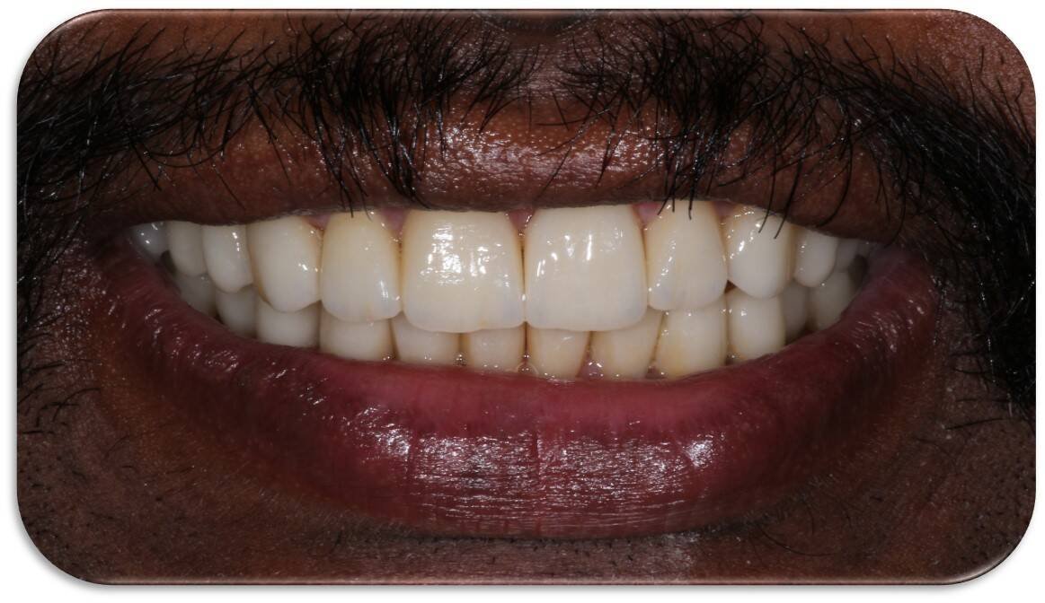 Tiny Pearls Dental Care - Post - Operative